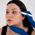 Is Face Lifting Threads Treatment Safe? What to Expect