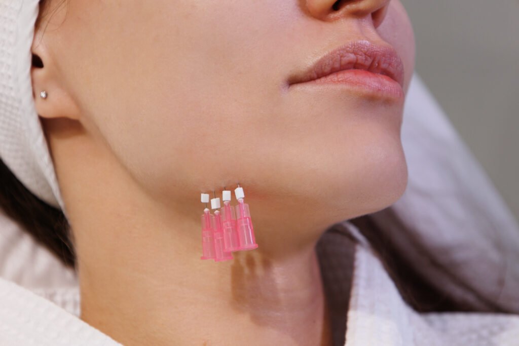 PDO Threads vs. Silhouette Soft: Which Is Better for a Face Lift?