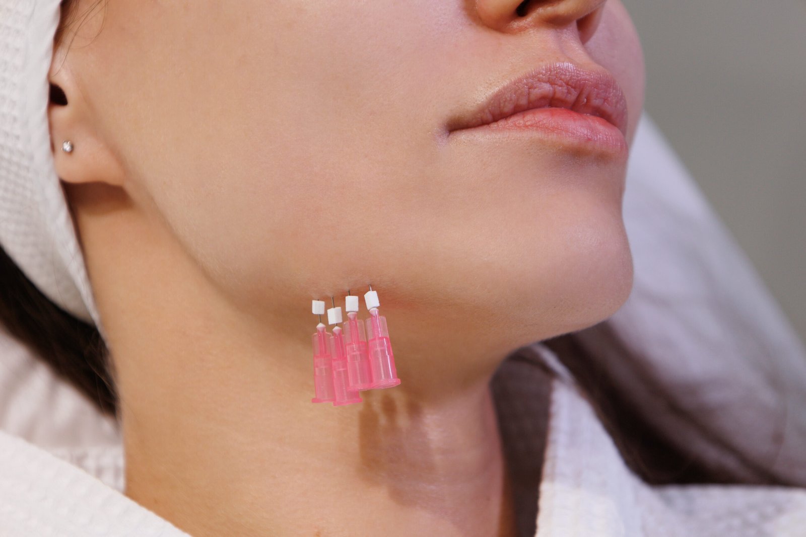 PDO Threads vs. Silhouette Soft: Which Is Better for a Face Lift?
